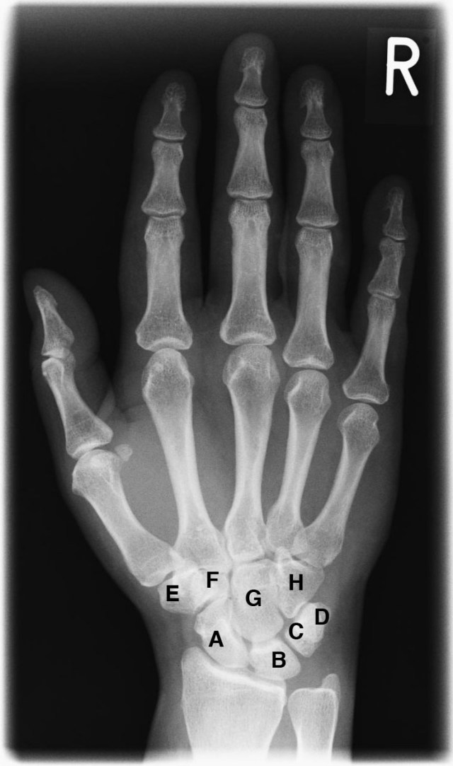 Xray_hand